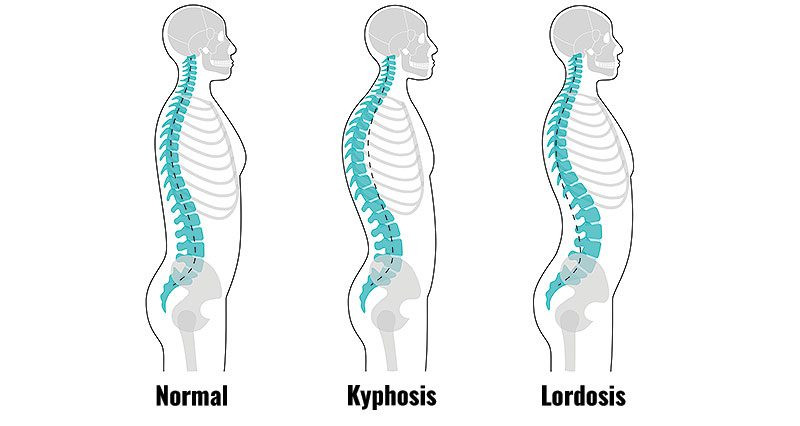 Hyperlordosis - What you should do as a personal trainer?